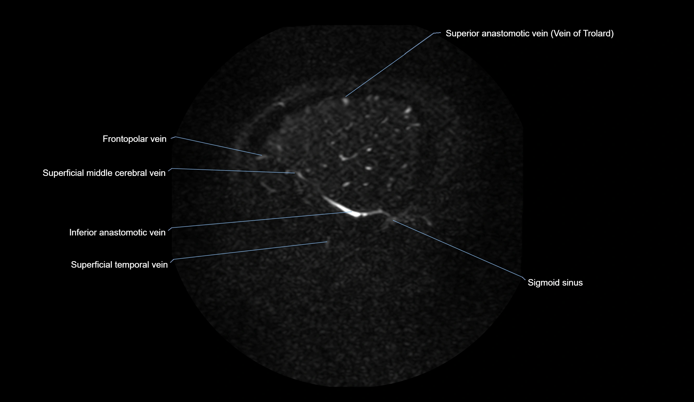 MRV brain sagittal anatomy 3T MRI labelledimages -00071.webp